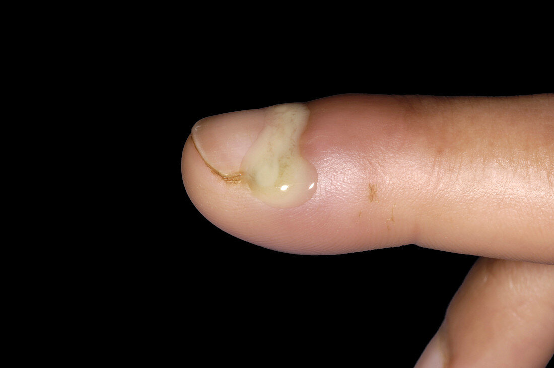 Paronychia on a finger