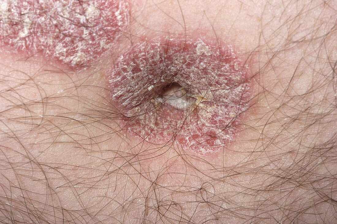 Chronic plaque psoriasis on navel