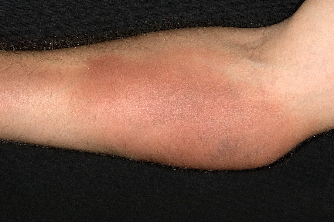 Superficial phlebitis in the lower arm