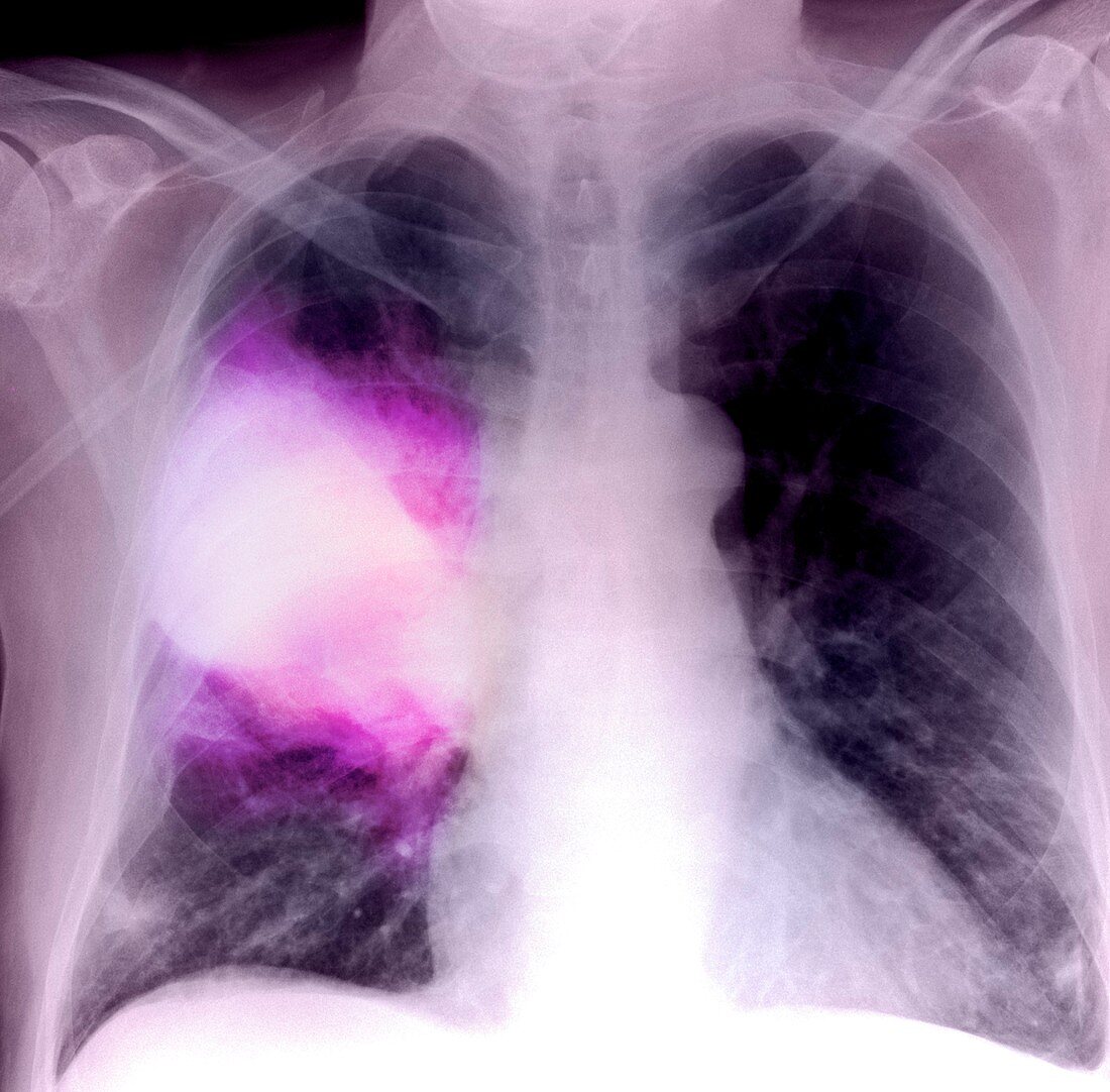 Pneumonia,X-ray