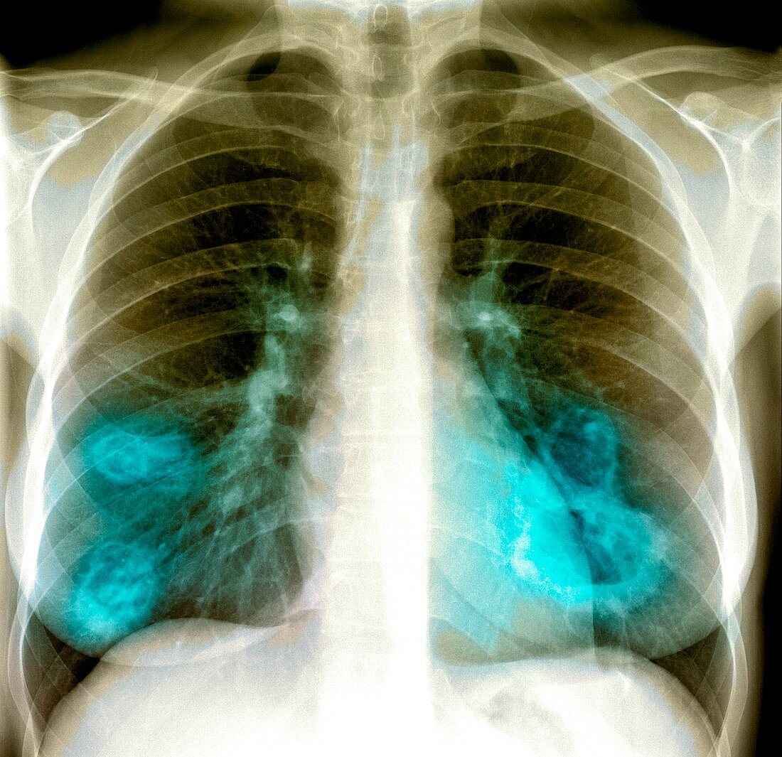 Lung lesions,X-ray