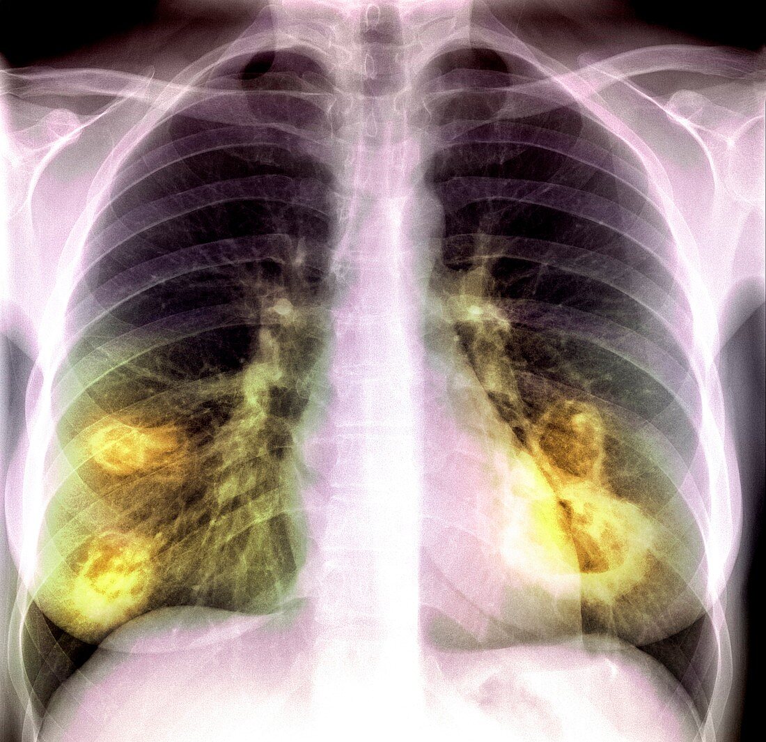 Lung lesions,X-ray