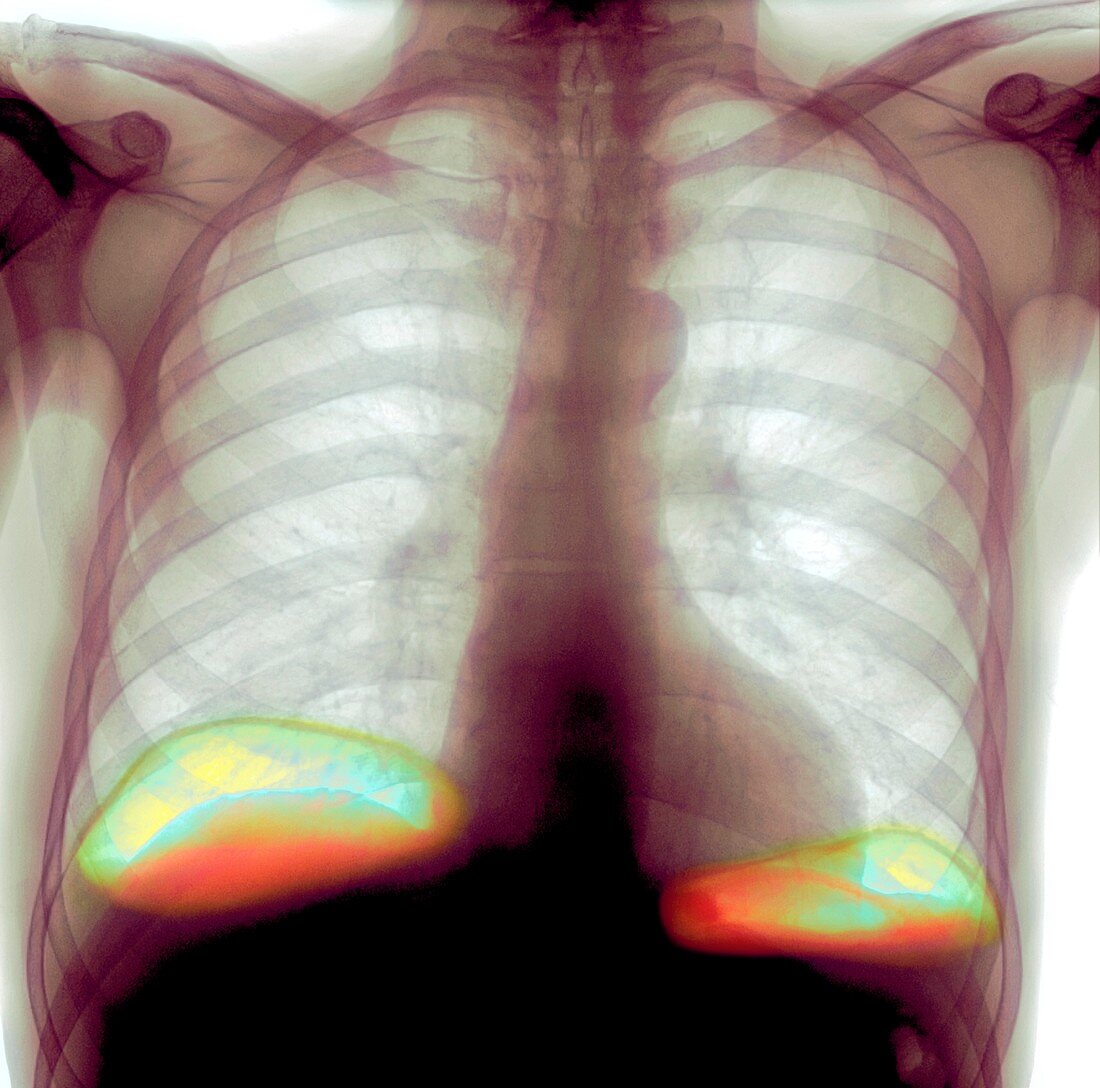 Abdominal air pocket,X-ray