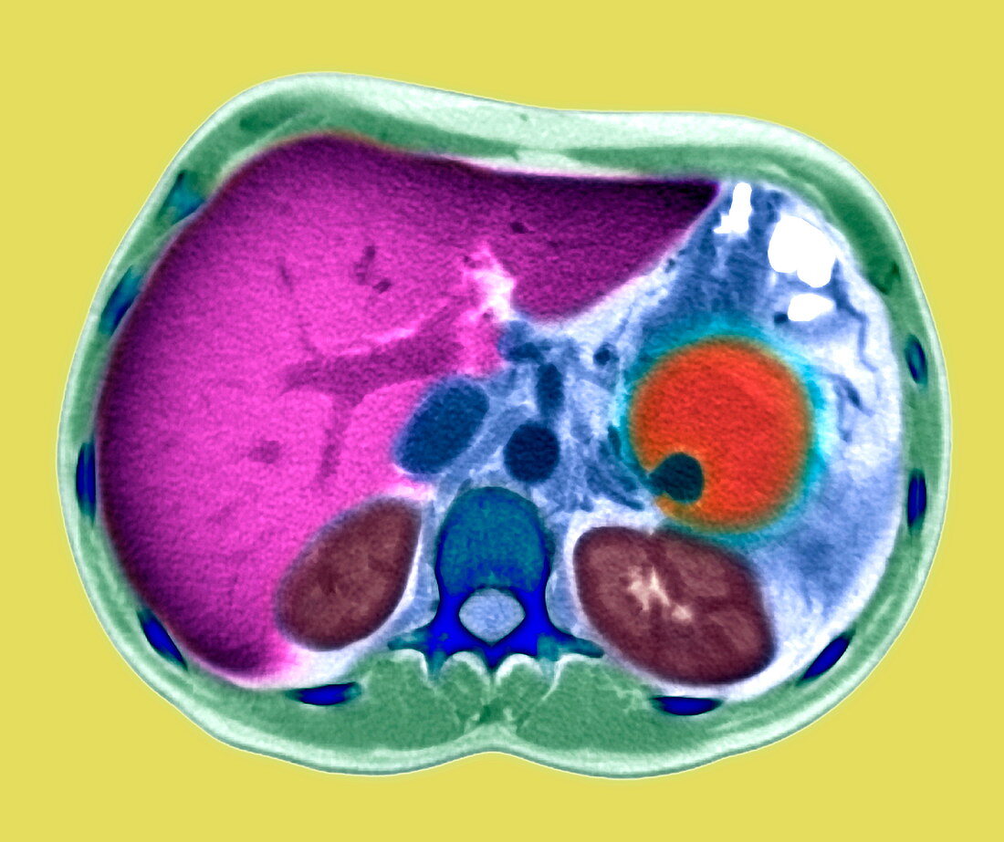 Pancreatitis,CT scan