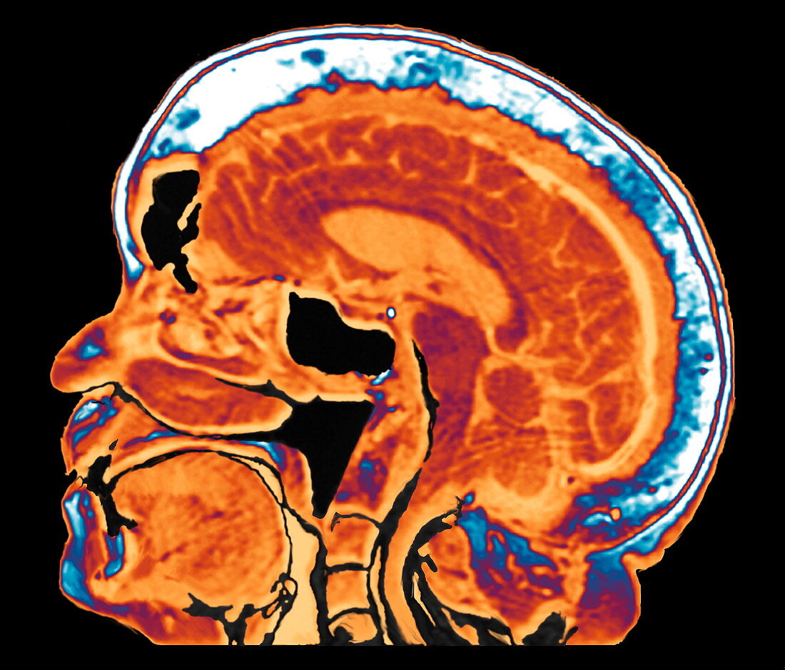 Paget's disease,MRI scan