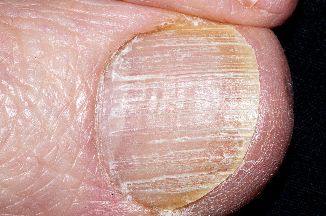 Psoriasis of a nail