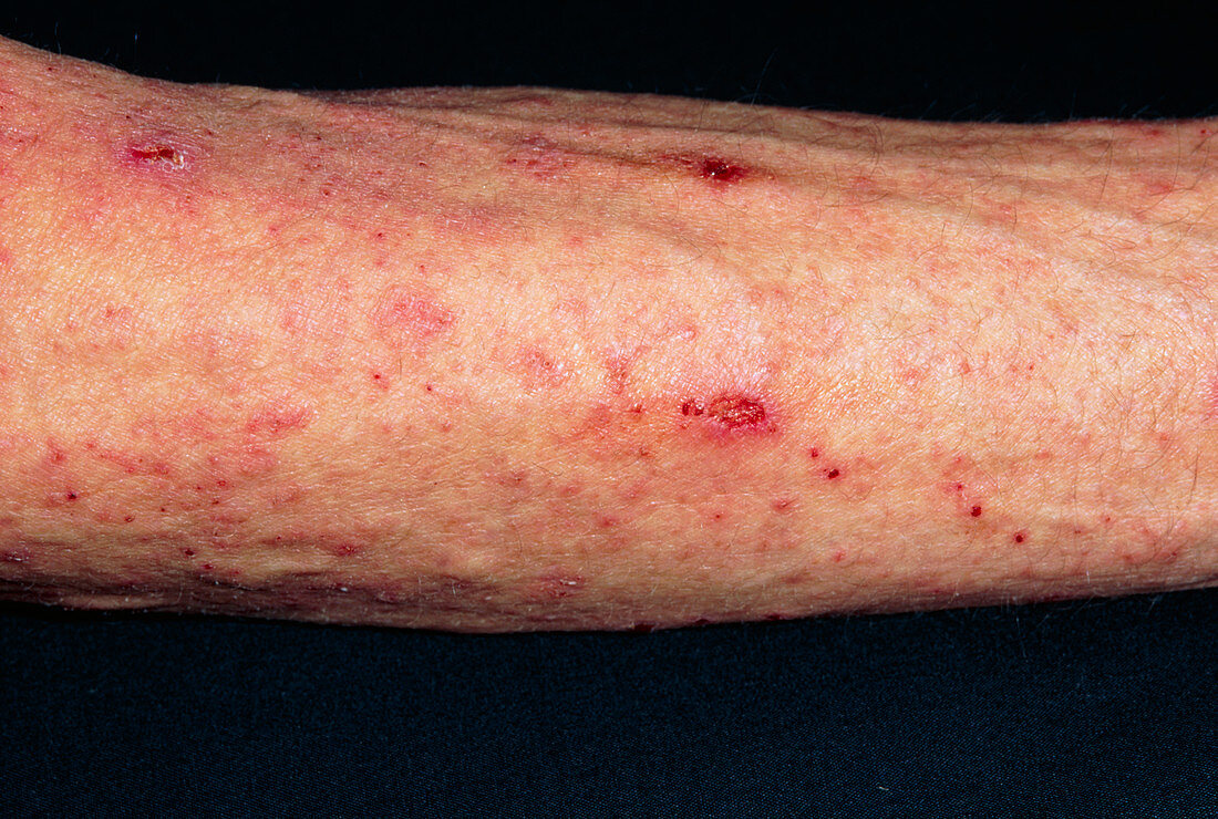 Scabies skin infection seen on man's arm