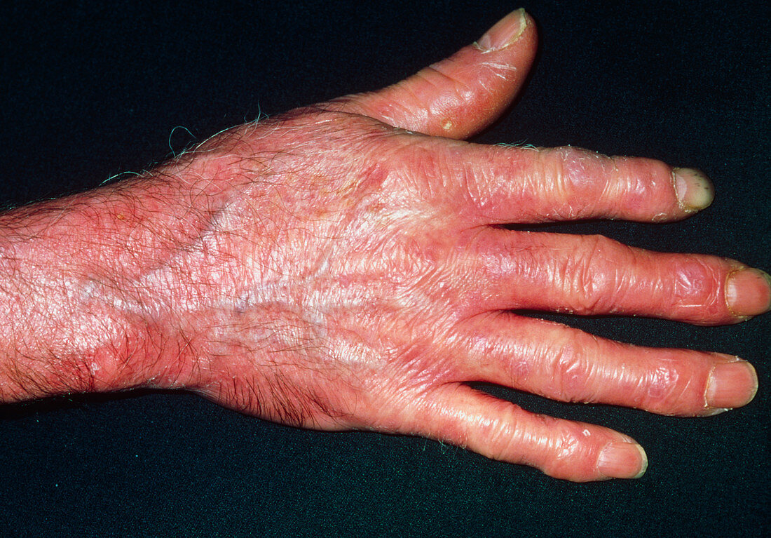Red,shiny & tight skin on hand due to scleroderma