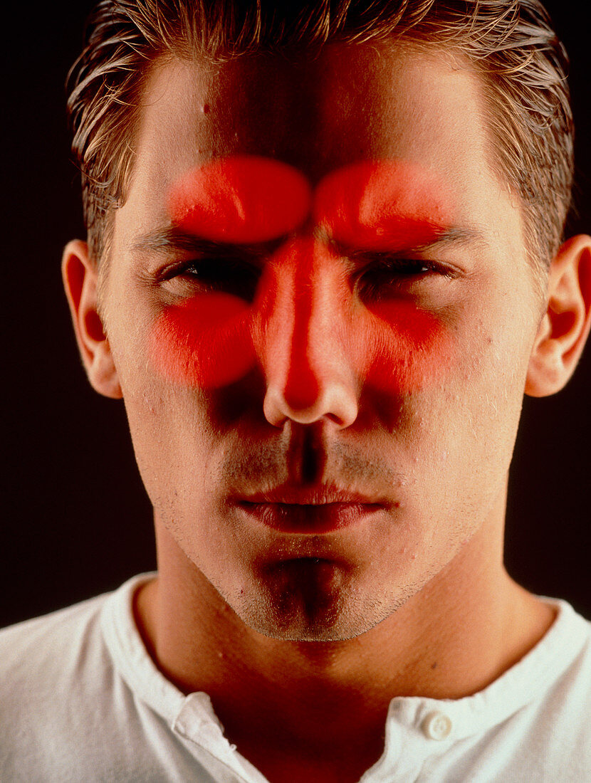 Sinusitis: male face with red sinuses highlighted