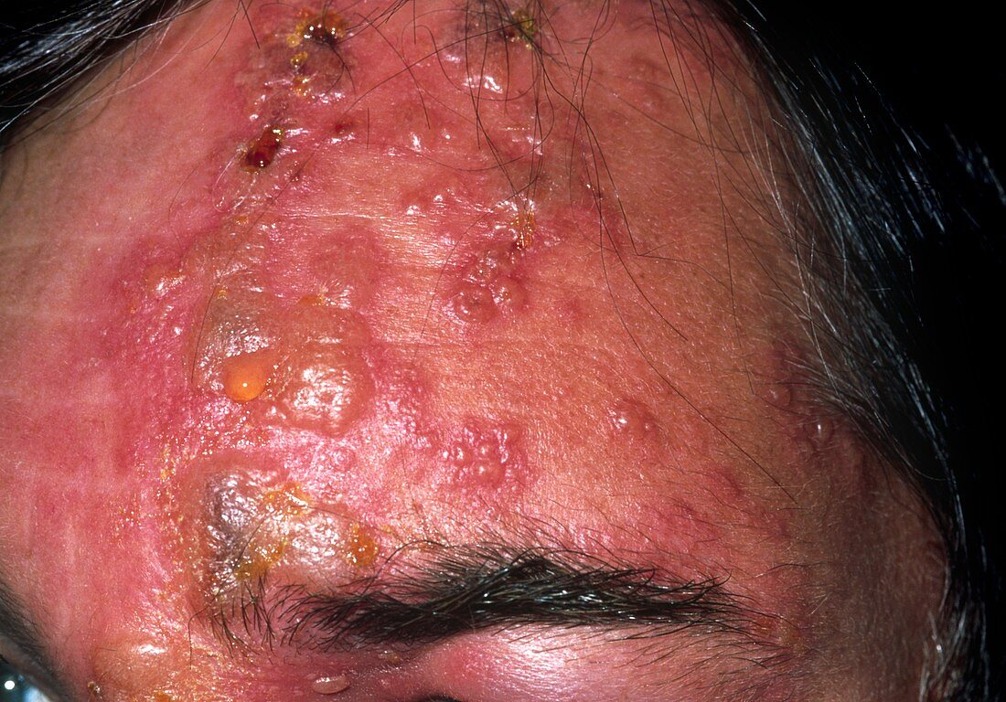 Shingles rash