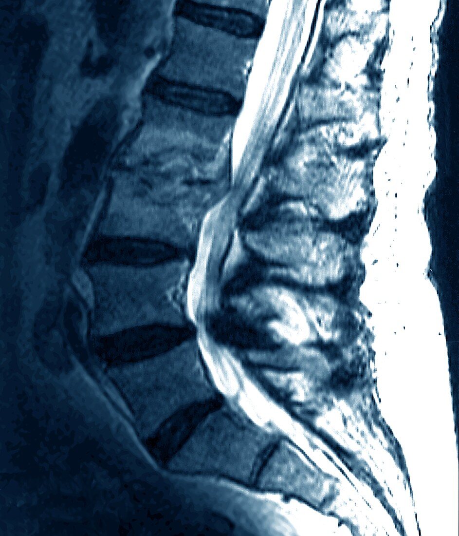 Spondylitis of spine,MRI