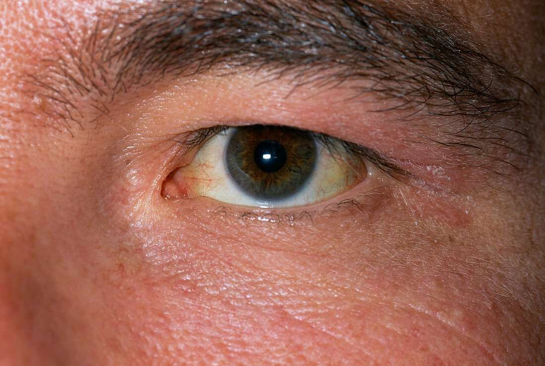 Jaundice due to spherocytosis