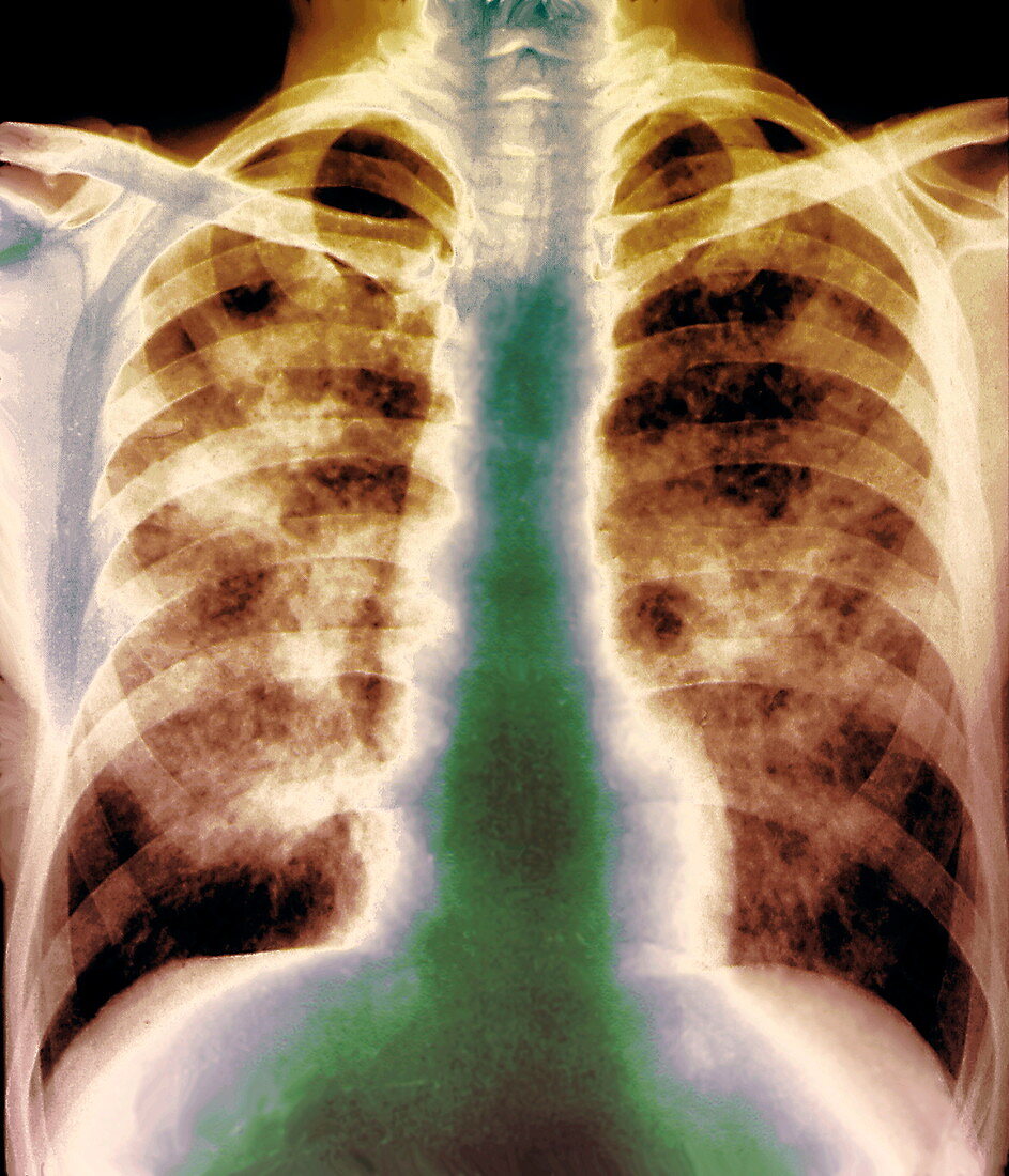 Lung silicosis,X-ray