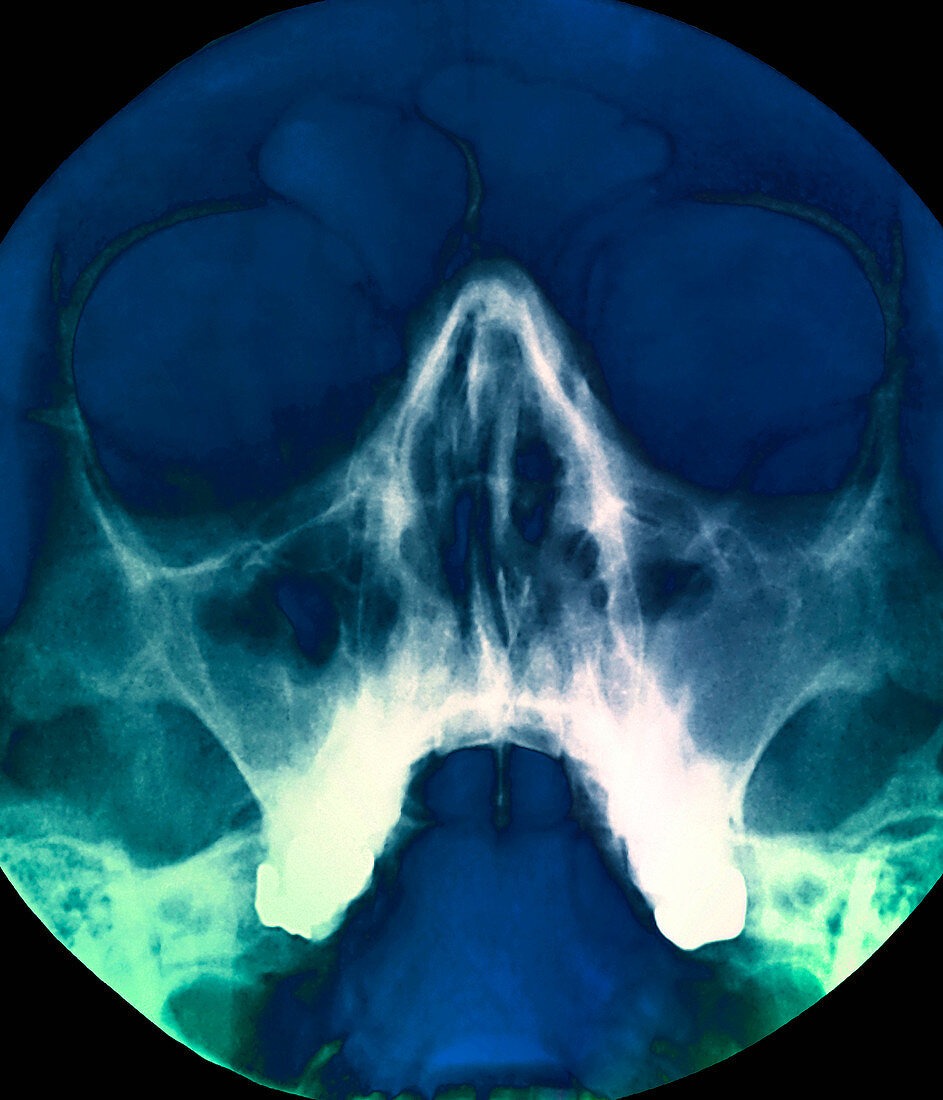 Sinusitis,X-ray