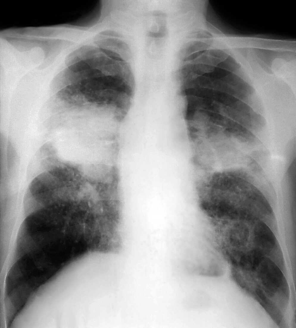 Silicotuberculosis of the lungs,X-ray