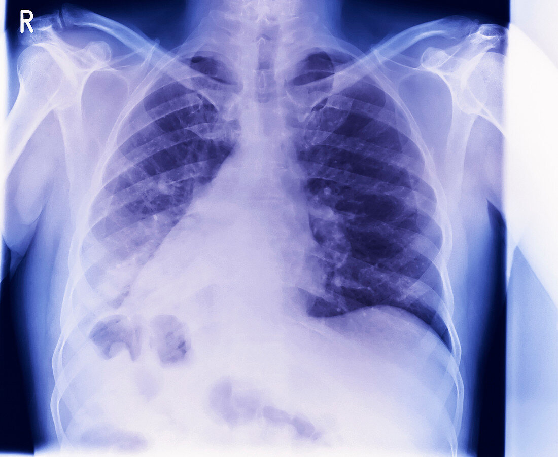 Reversed organs,X-ray