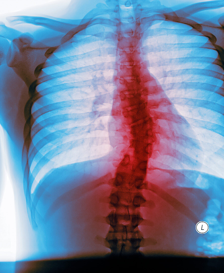 Curved spine,X-ray