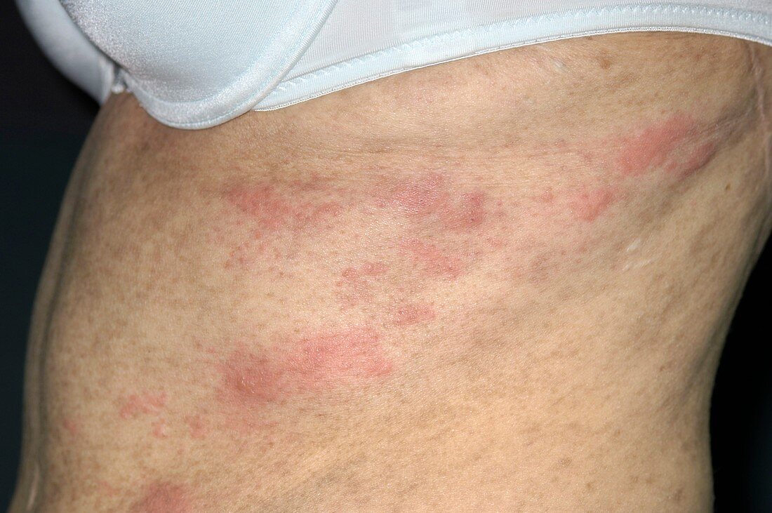 Shingles rash in leukaemia patient