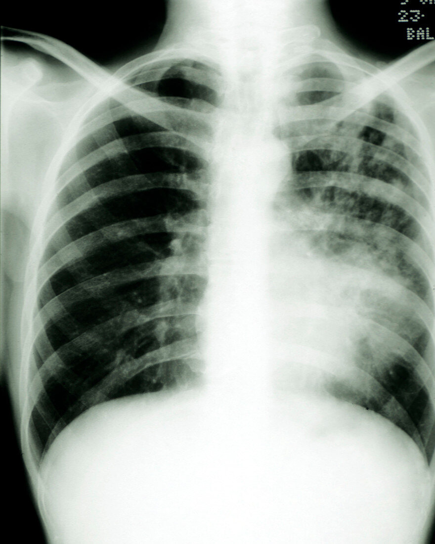X-ray of human chest showing pulmonary TB