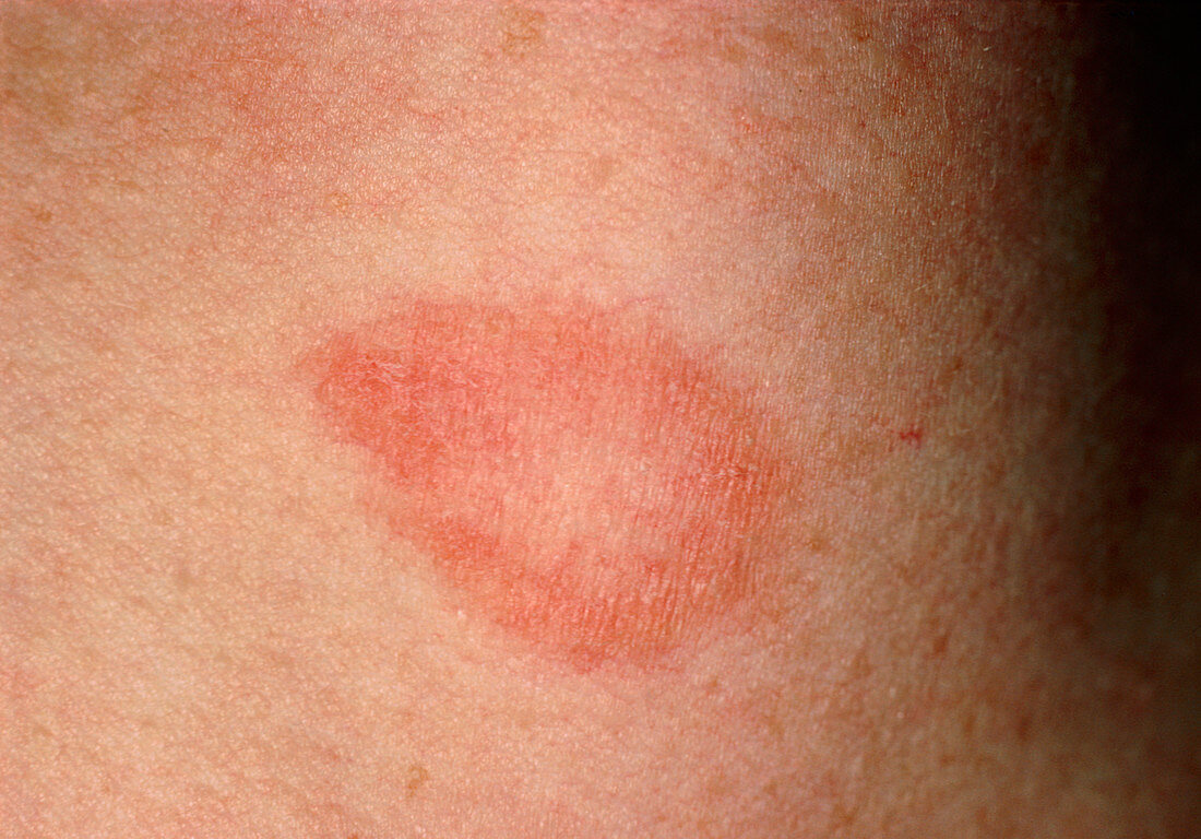 Minor ringworm infection on woman's neck