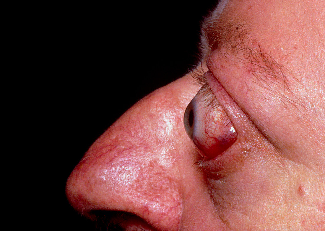 Protrusion of the eyes in thyrotoxicosis