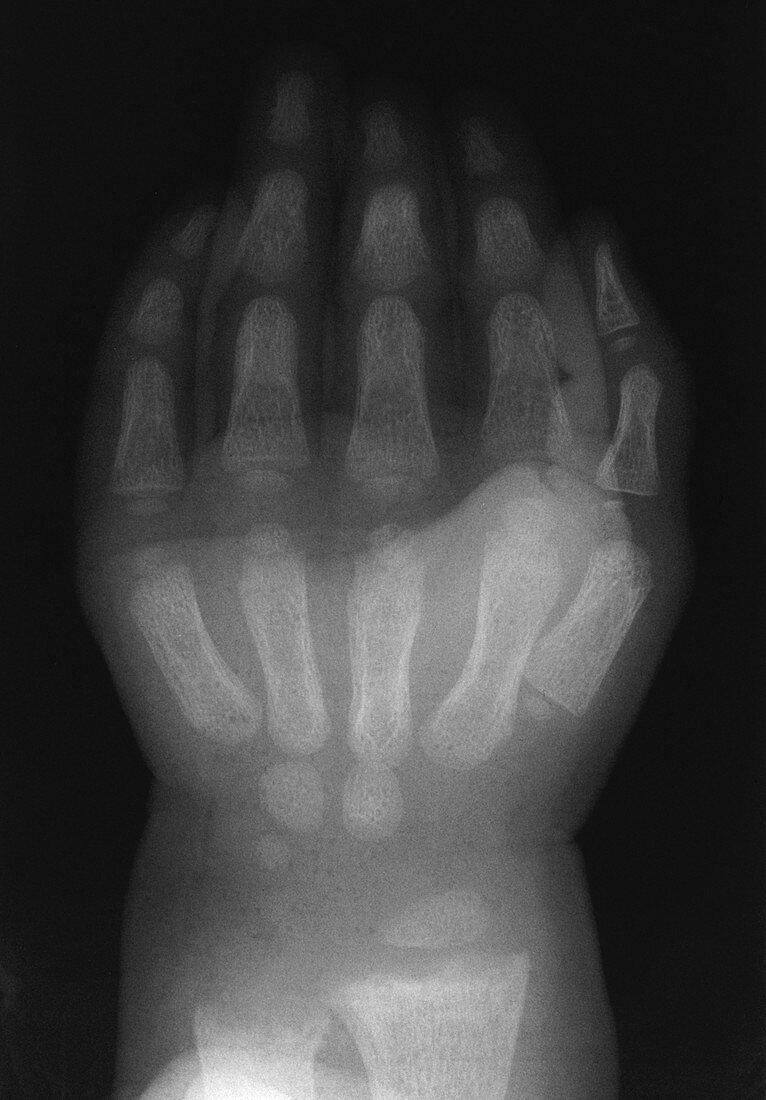 X-Ray of hand & wrist in a child with rickets