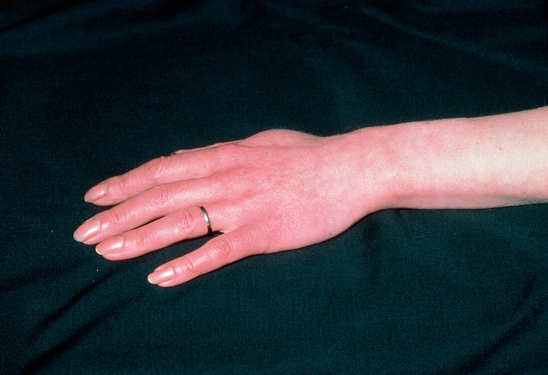 Raynaud's phenomenon in woman's hand