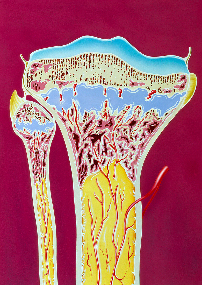 Artwork of rickets in tibia and fibula bones