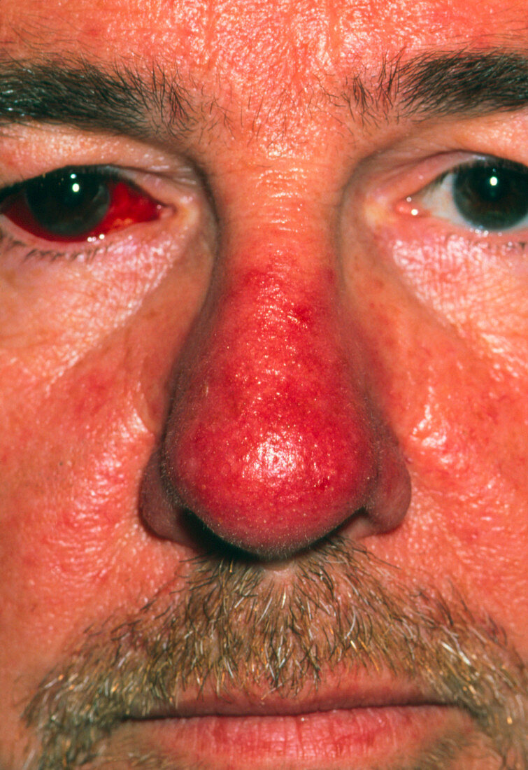 Red nose of patient with rhinophyma
