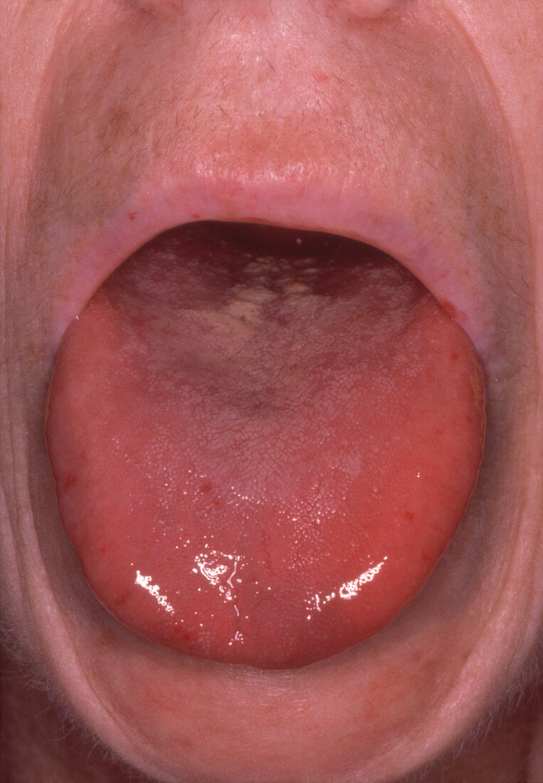 Tongue showing the presence of Raynaud's disease