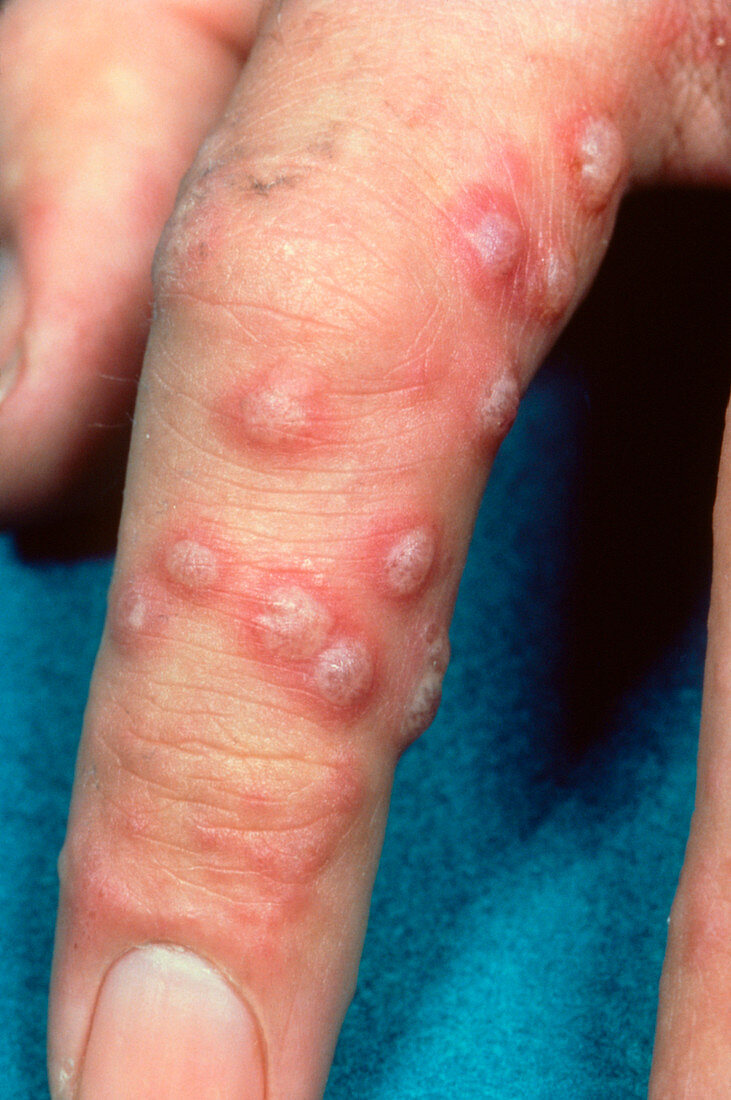 Shingles caused by virus Herpes zoster