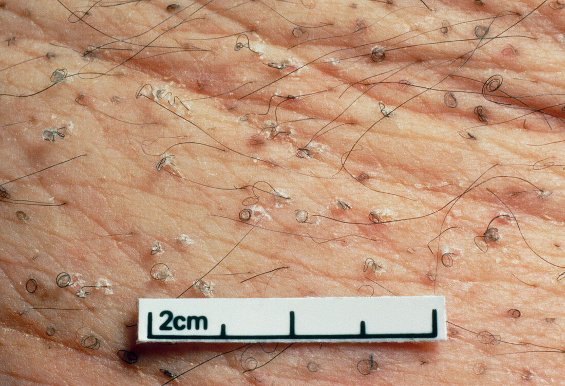 Corkscrew hairs on skin of scurvy patient