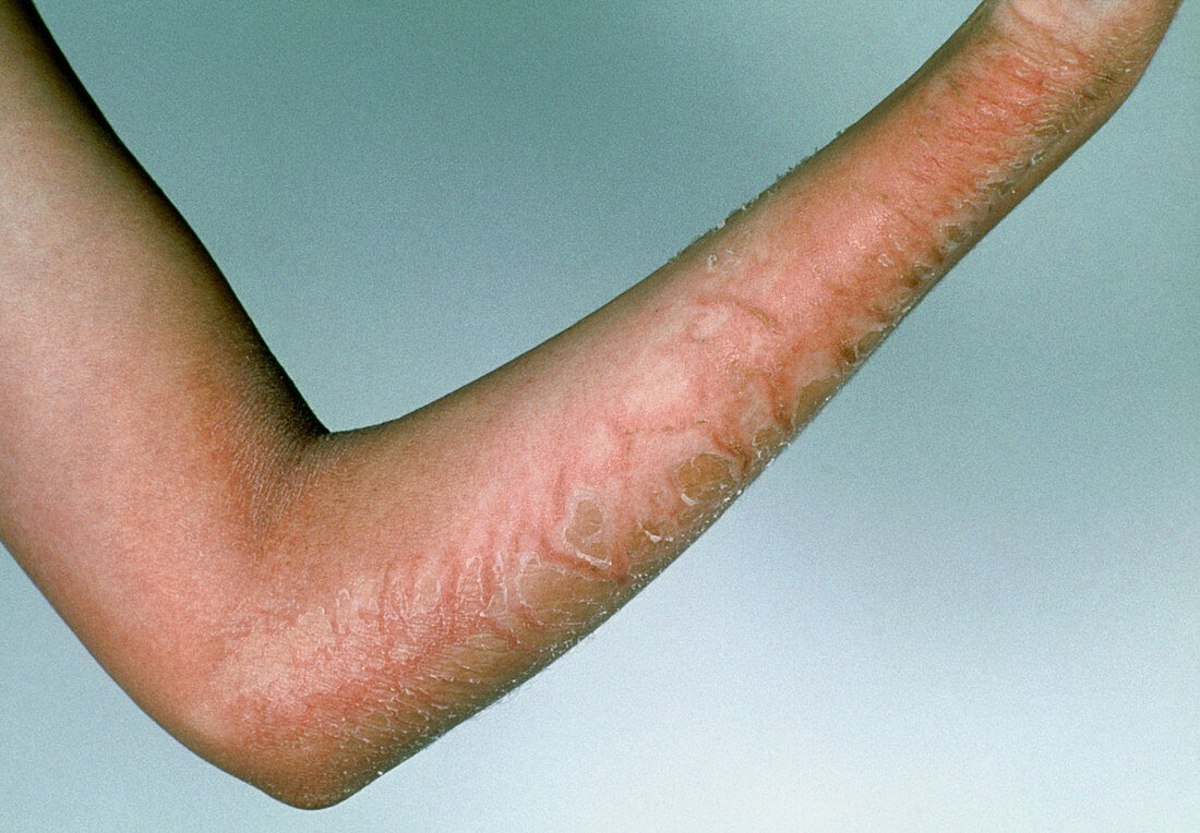 Scarlet fever rash on young person's arm