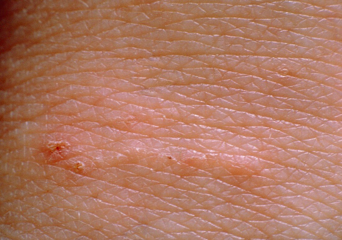 Scabies rash on skin