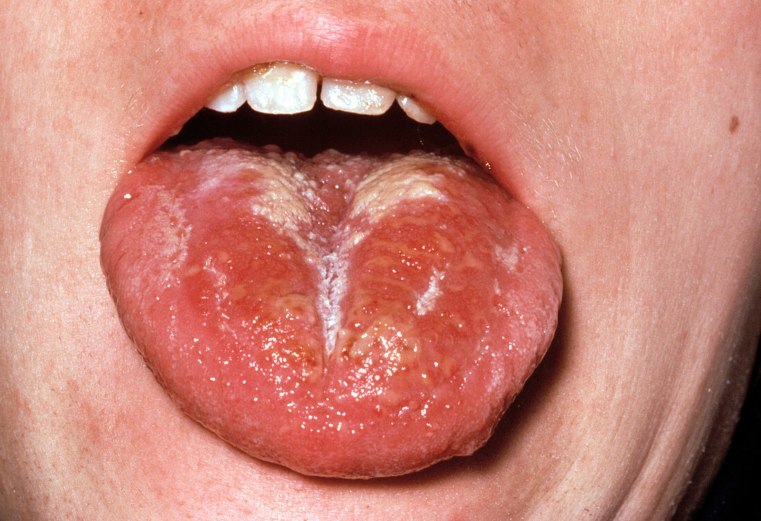 Scarlet fever rash on tongue