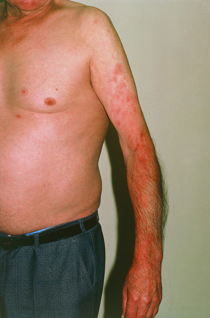 Photograph of shingles caused by Herpes Zoster