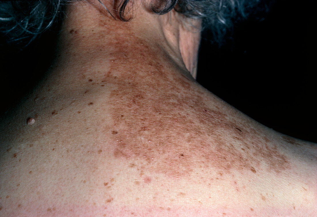 Rash on back following shingles (herpes zoster)