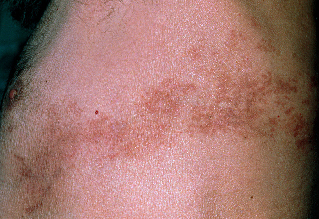 Pigmentation of skin under arm due to shingles