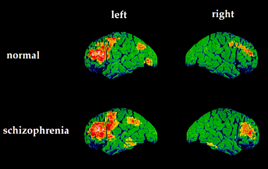 Colour PET brain scans of schizophrenic speaking