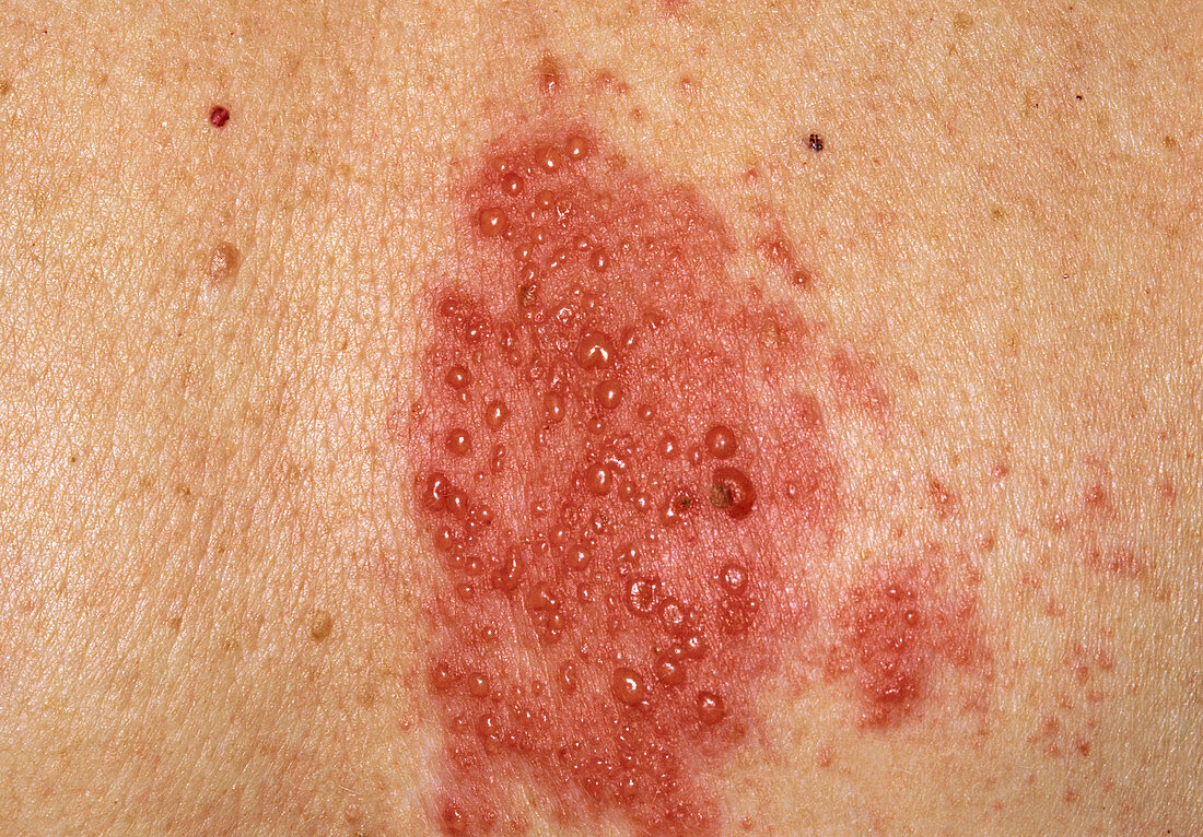 Herpes zoster blisters on a woman's back