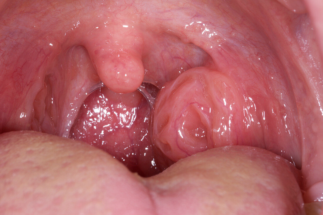 Unilateral tonsil enlargement