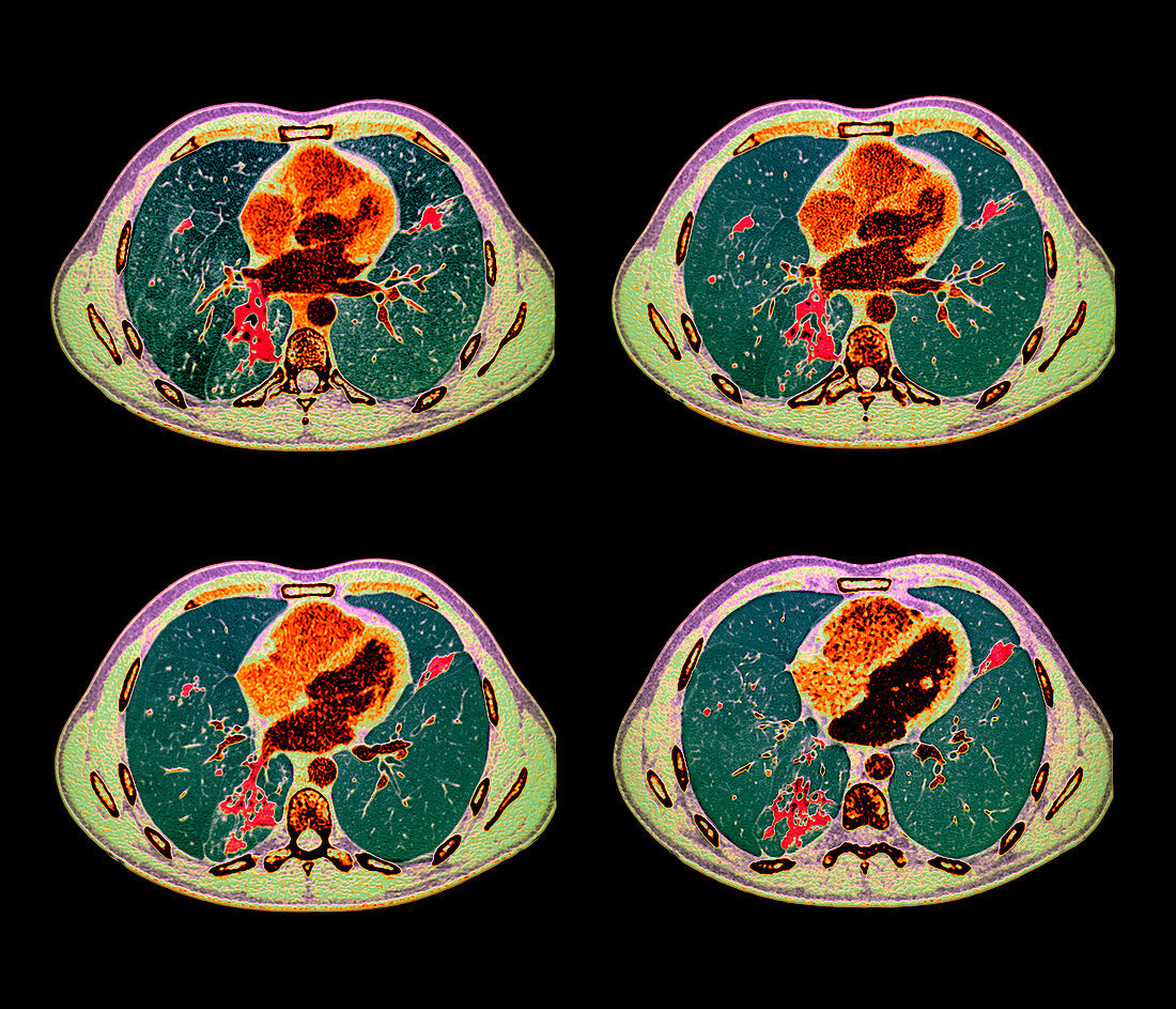 Tuberculosis,CT scans