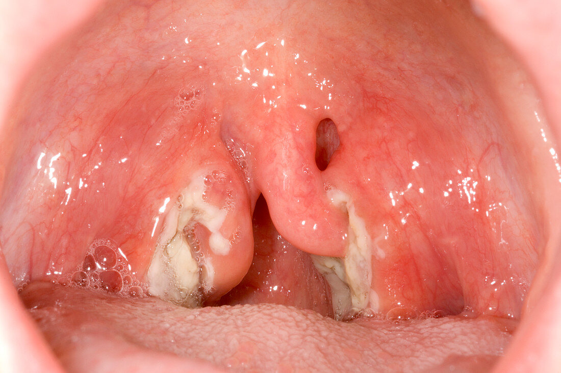 Bacterial tonsillitis