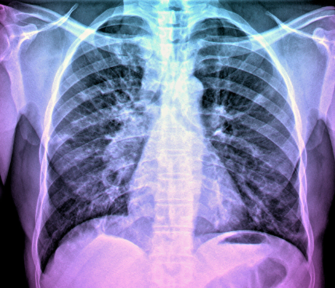 Tuberculosis pneumonia,X-ray