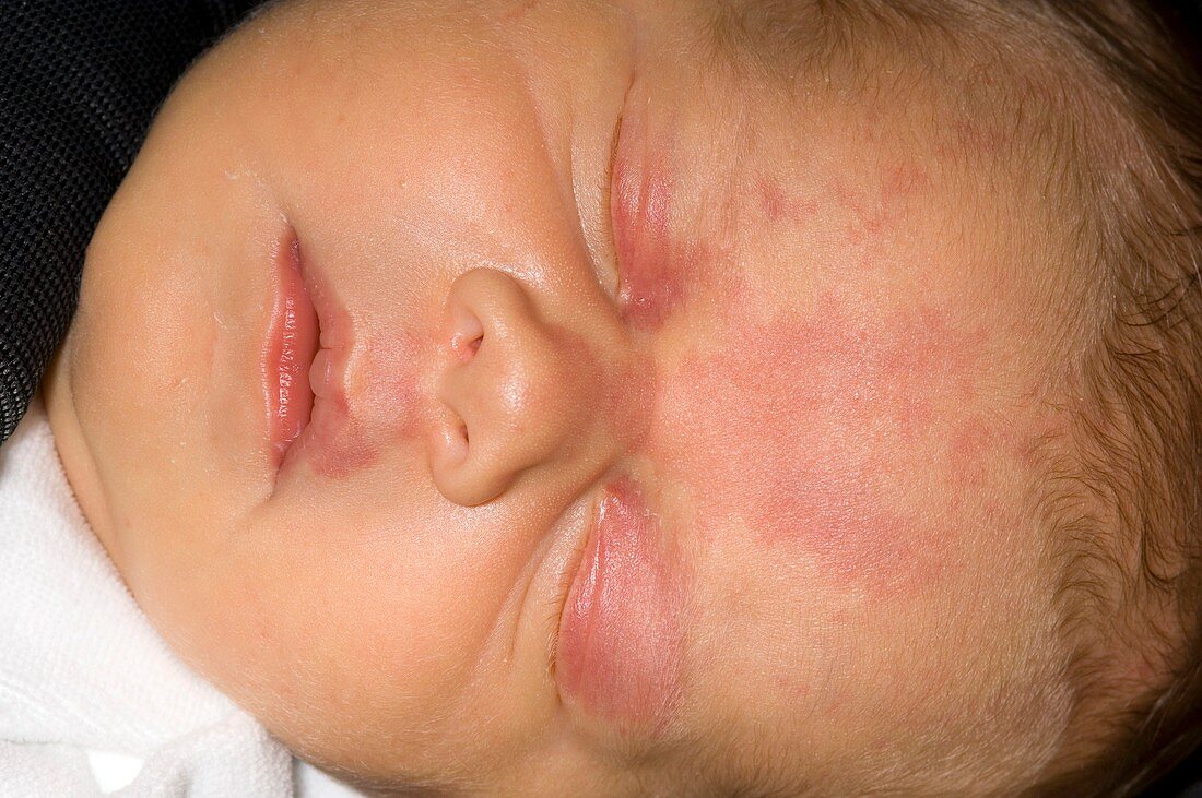 Baby with stork bite birthmarks