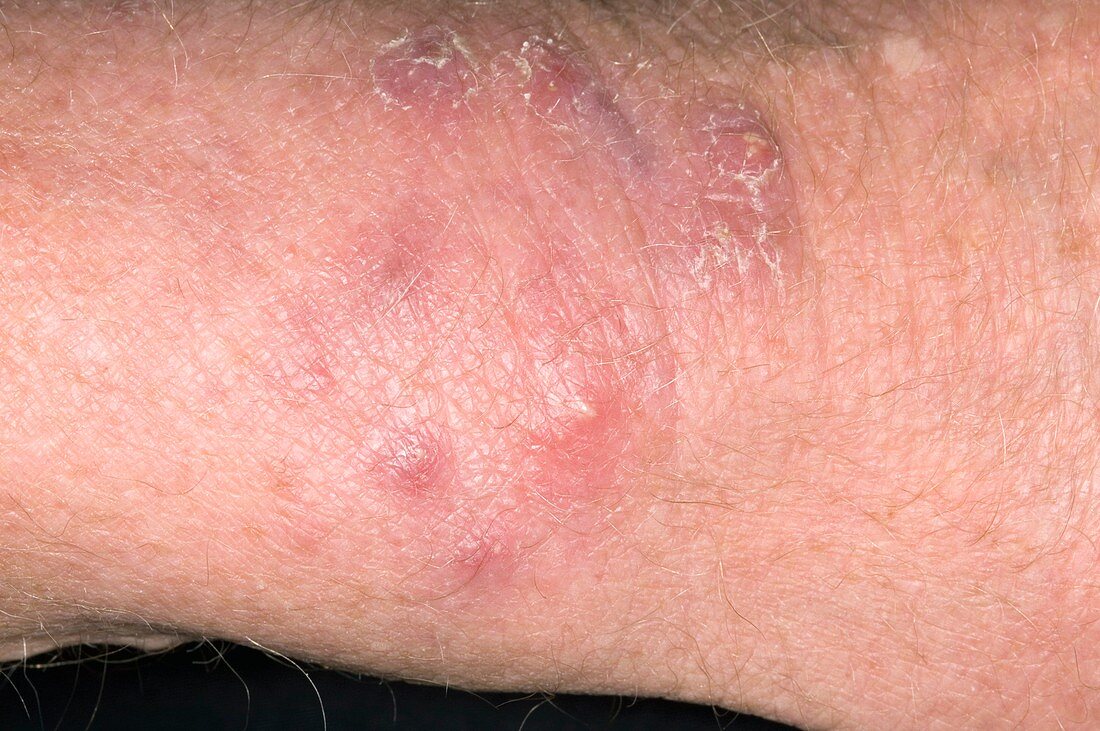 Ringworm skin infection