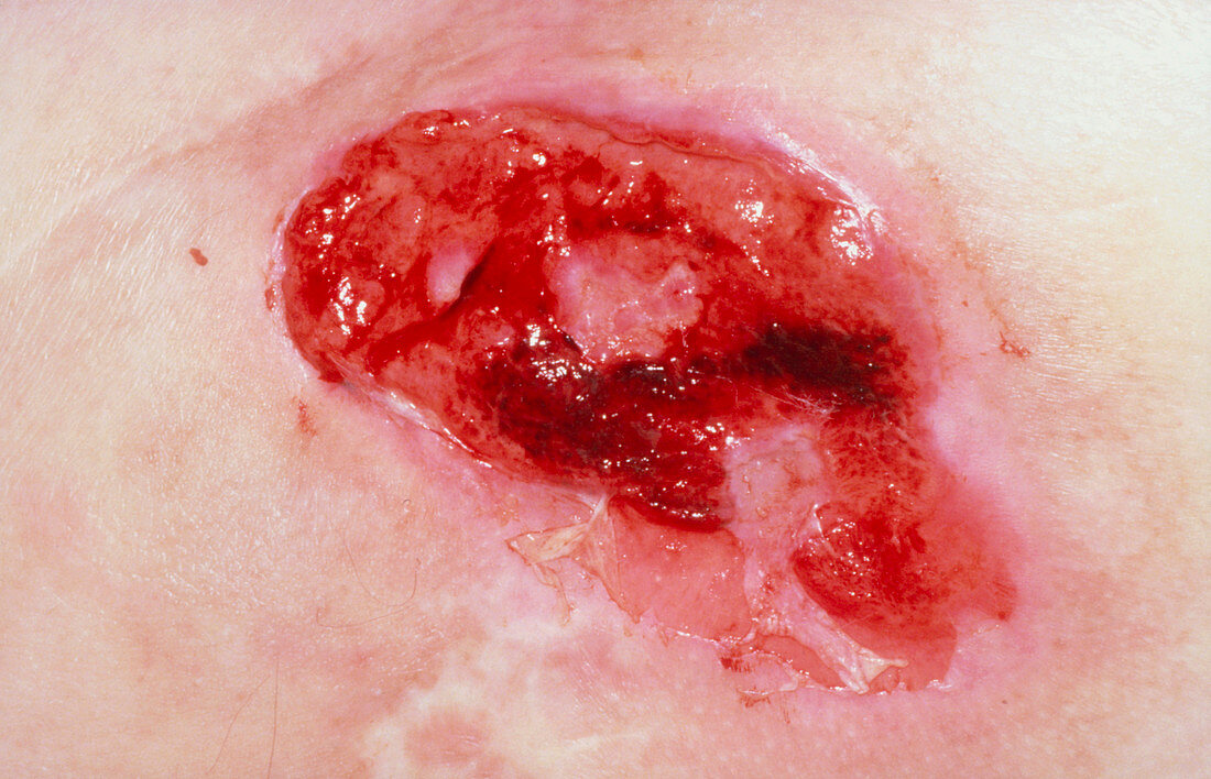 Close up of a pressure/bedsore (decubitis ulcer)
