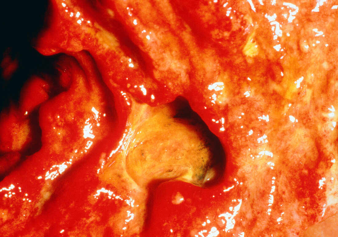 Close-up clinical shot of duodenal ulcer