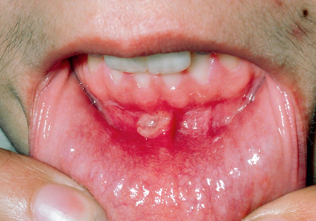 Aphtha (mouth ulcer) on base of gums