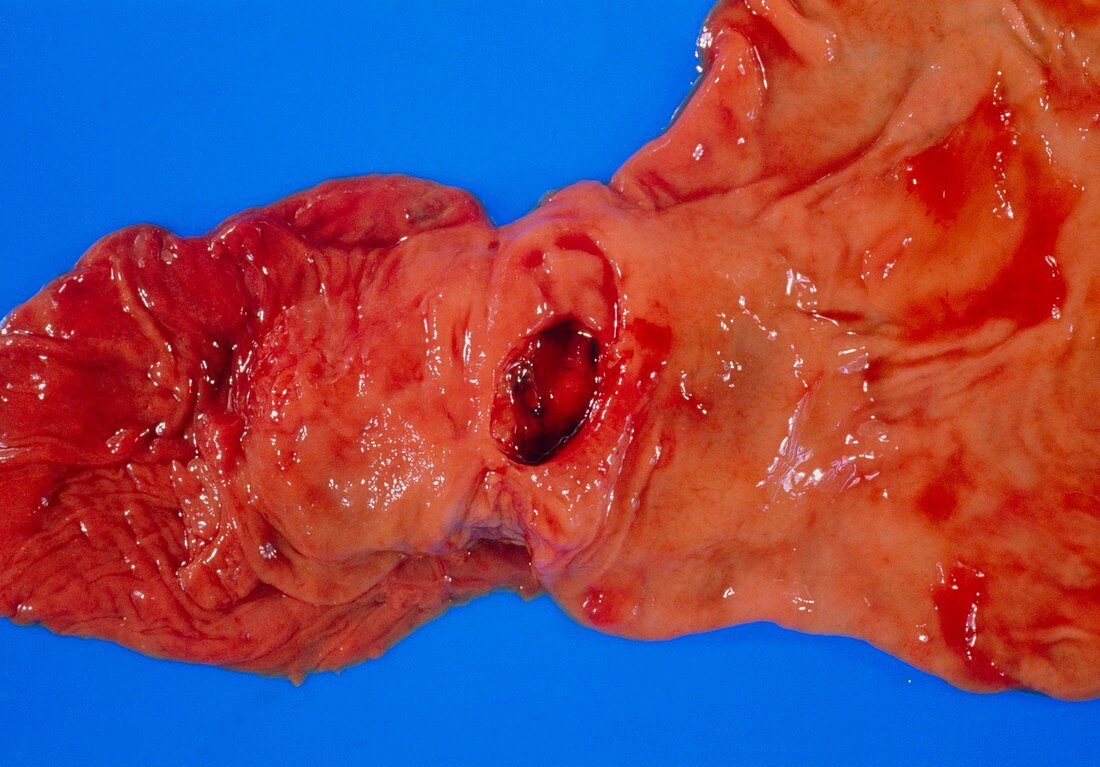 Bleeding gastric ulcer in excised part of stomach